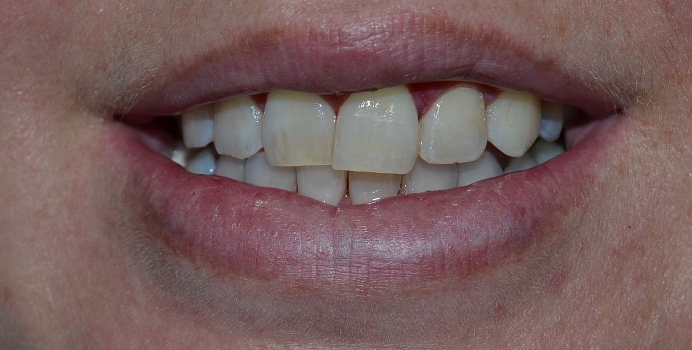 Before dental treatments