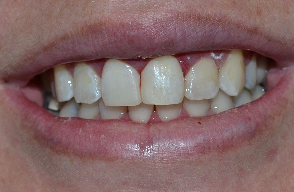 After dental treatments
