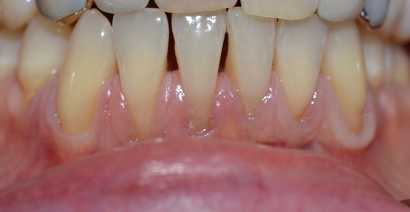 Before dental treatments