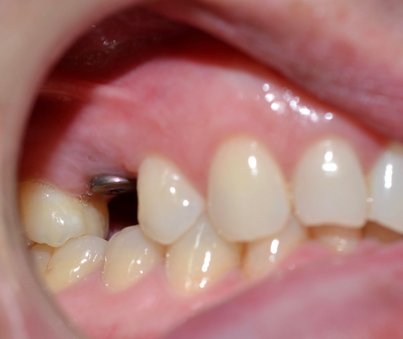 Before Dental Implant Procedure