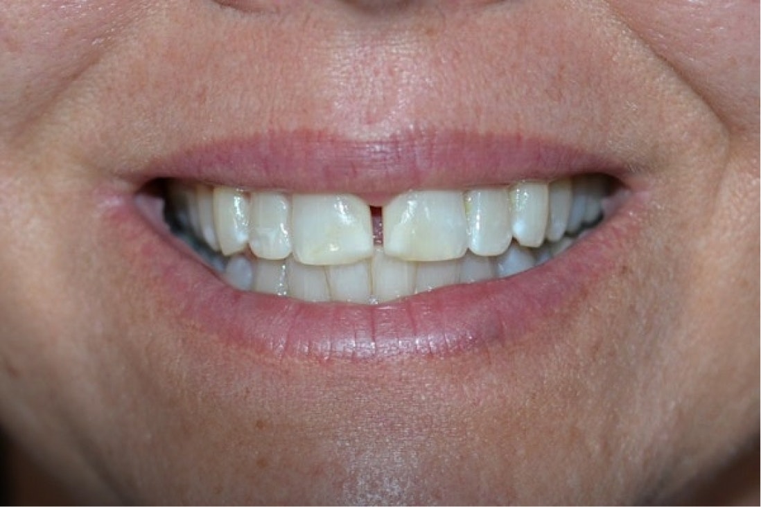 Albuquerque dental patient before crowns