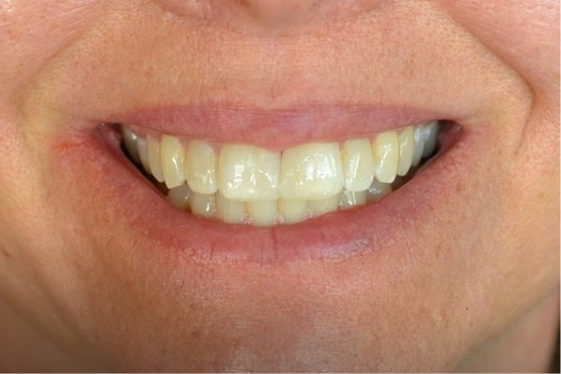 Albuquerque dental patient after crowns